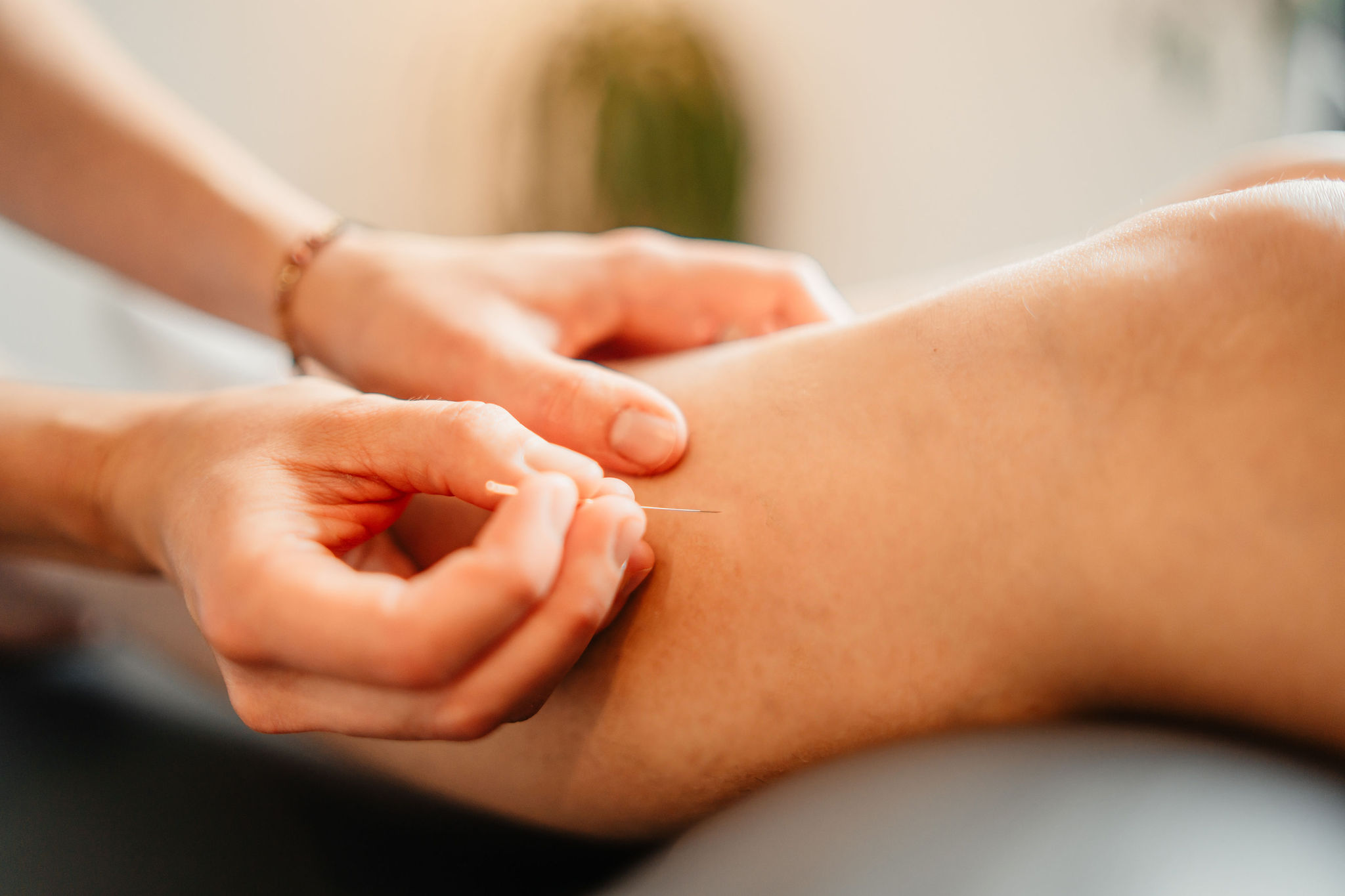 Technique dryneedling